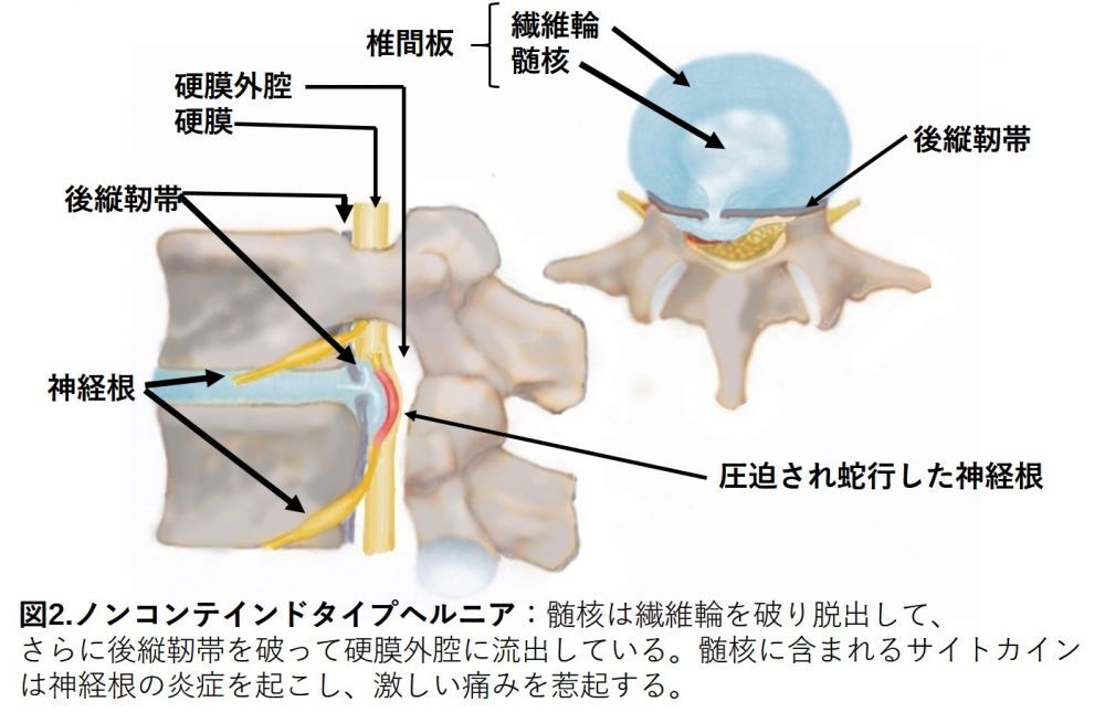 2. ノンコンテインドタイプのヘルニア