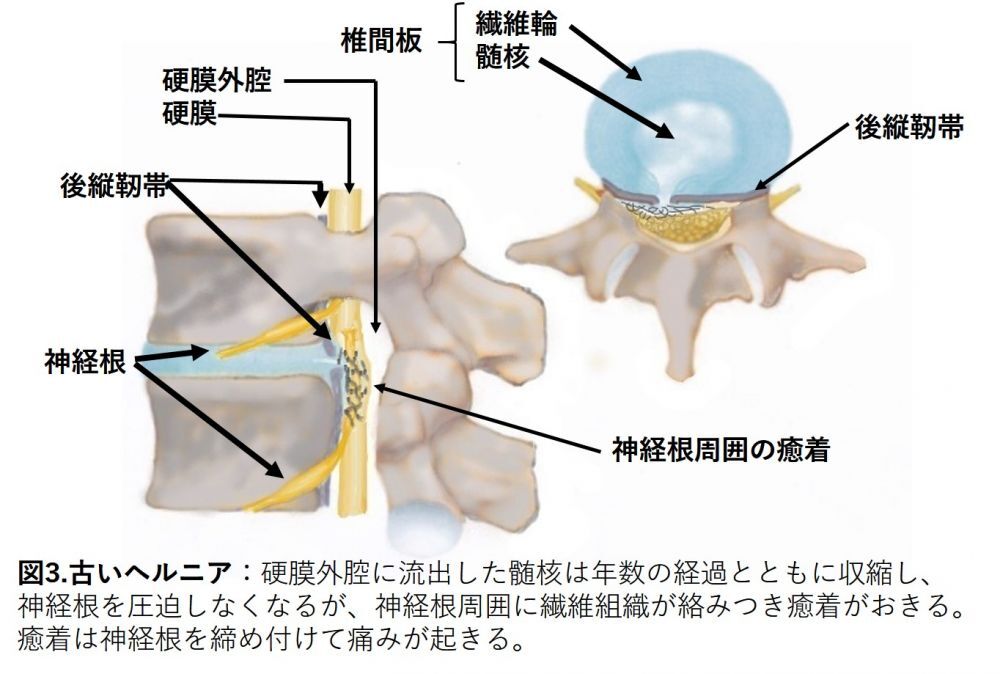 3. 慢性化したヘルニア