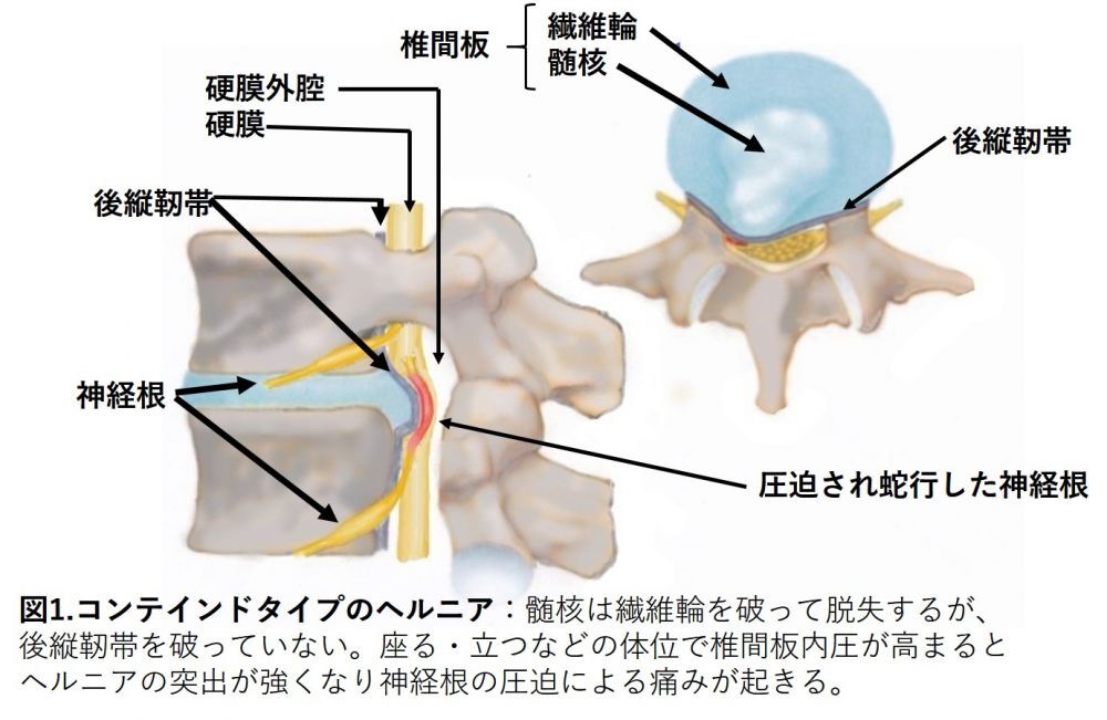 1. コンテインドタイプのヘルニア