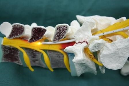 図4：硬膜外内視鏡下神経剥離術